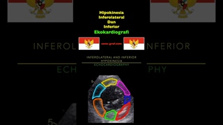 Ekokardiografi - Hipokinesia Inferolateral Dan Inferior