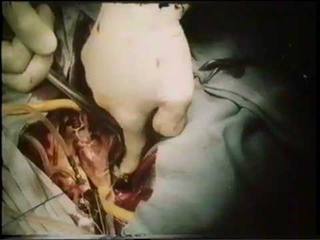 Митральные пороки сердца  Surgery mitral heart defects